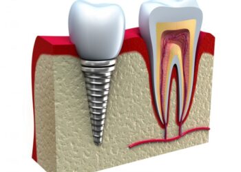 Dėl prastos dantų būklės vis daugiau Lietuvos jaunimo netenka dantų